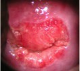 /album/fotogaleria-colposcopia/eversion-glandular-o-ulcera-del-cuello-jpg/
